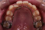 舌側弧線装置
