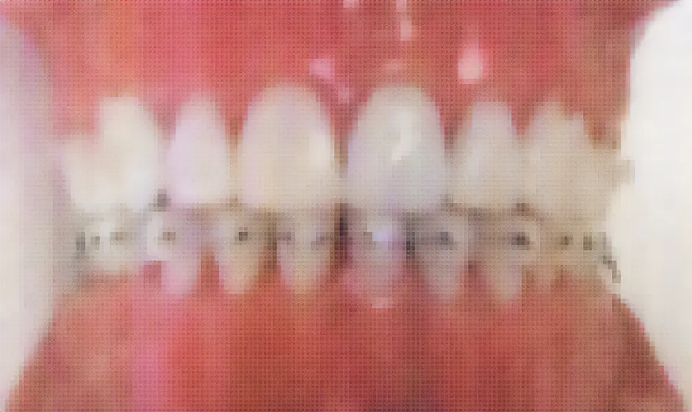 歯周治療