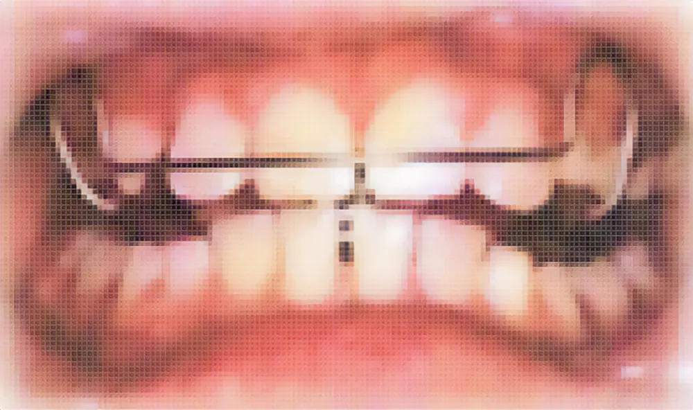 歯周治療